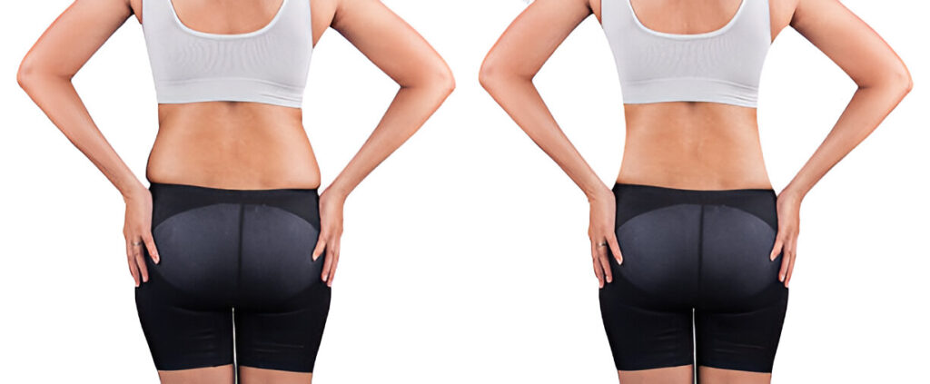 Body Contouring