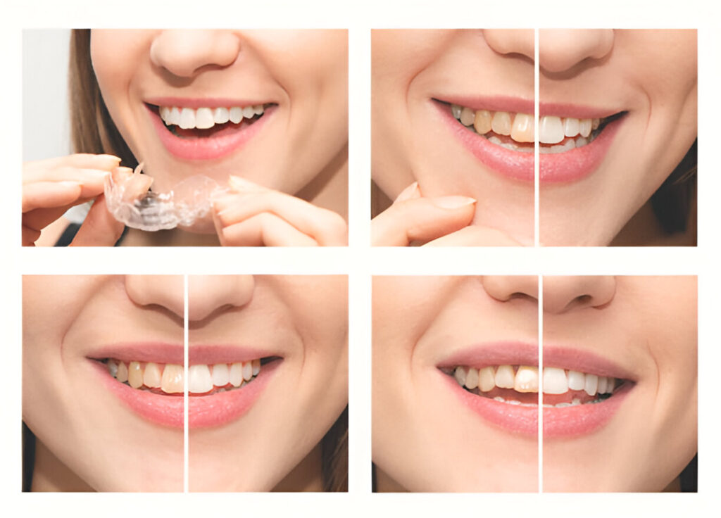      Benefits of Invisalign Compared to Traditional Braces in Surrey