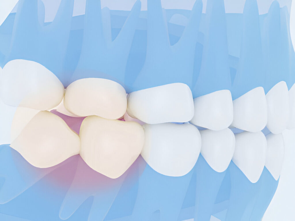 Wisdom Teeth Extraction